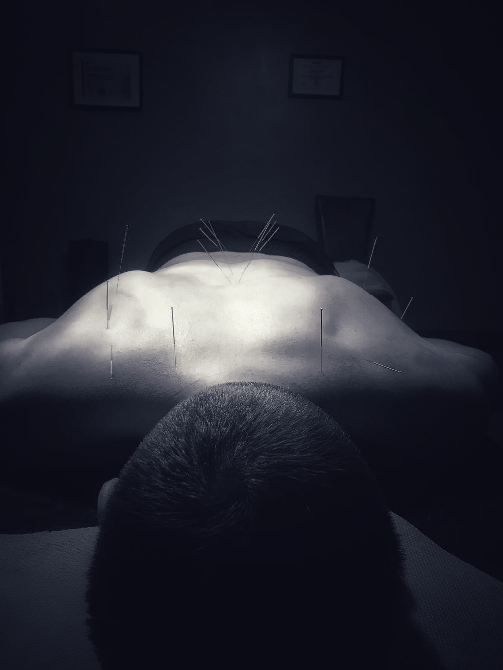 Dry Needling